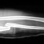 A fractured arm shown on an X-ray