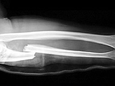 A fractured arm shown on an X-ray