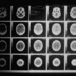 CAT scan imaging of an injured human brain