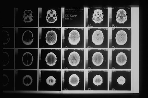 Chatsworth Traumatic Brain Injury Compensation Amount thumbnail