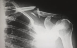 X-ray photo of an adult human with a broken shoulder 